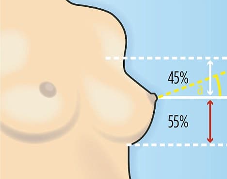 Cosmetic result 5: excellent (perfect shape of the breast even with the