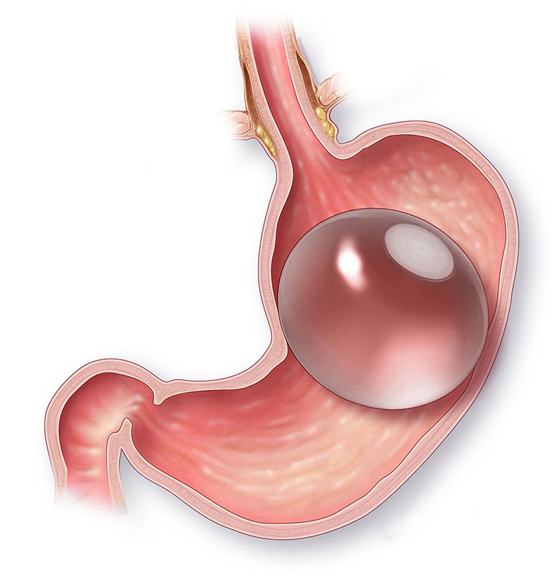 Endoscopic & Non Endoscopic Gastric Balloon - SHAMMA Clinic | SHAMMA Clinic